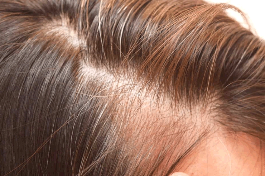 Pilopeptan Woman Proteokel: La revolución anticaída del cabello