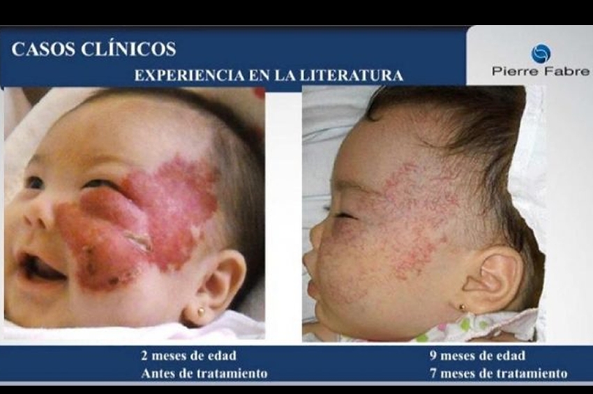 El Hemangioma Infantil (HI), es el tumor benigno más frecuente en la infancia. El nuevo propranolol oral es útil para su tratamiento
