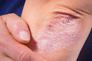 Psoriasis, enfermedad de la piel que se puede presentar a cualquier edad; fundamental su diagnóstico y tratamiento para mejorar calidad de vida