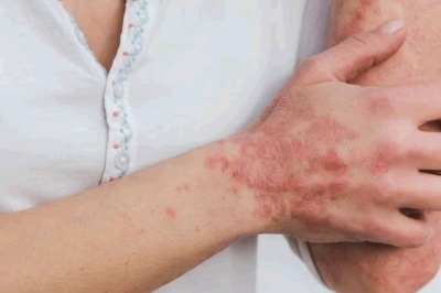 Psoriasis Pustulosa Generalizada: enfermedad de la piel que impacta la salud mental