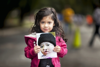 Operation Smile México y CMH inician programa en beneficio de niños con labio y/o paladar hendido